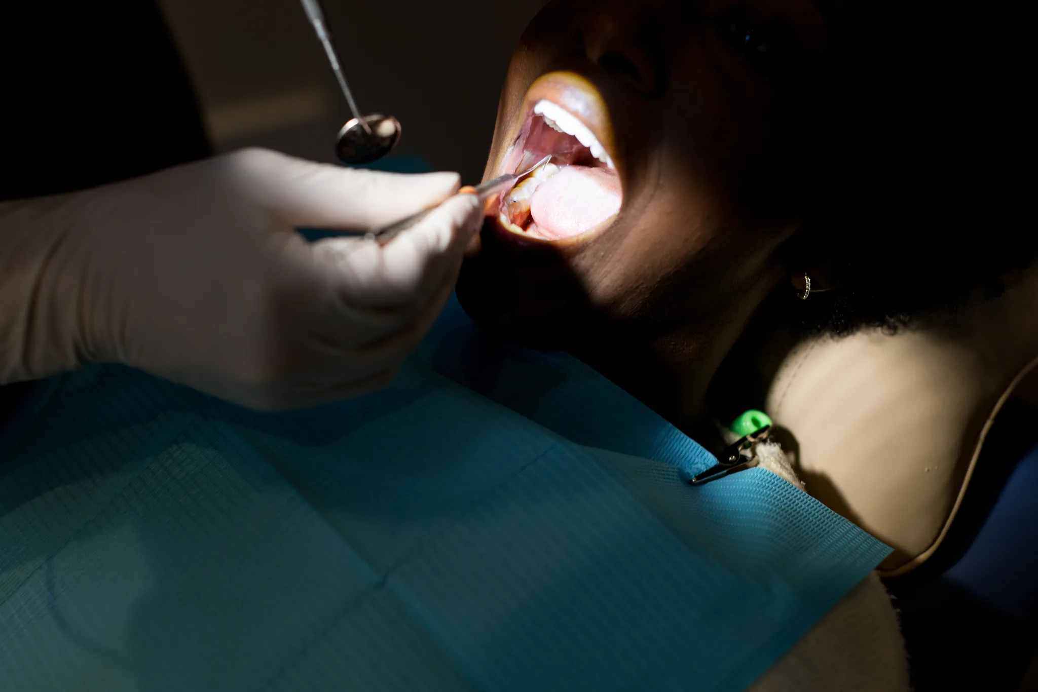 A gloved hand retracting a patient's lip with a mirror during treatment