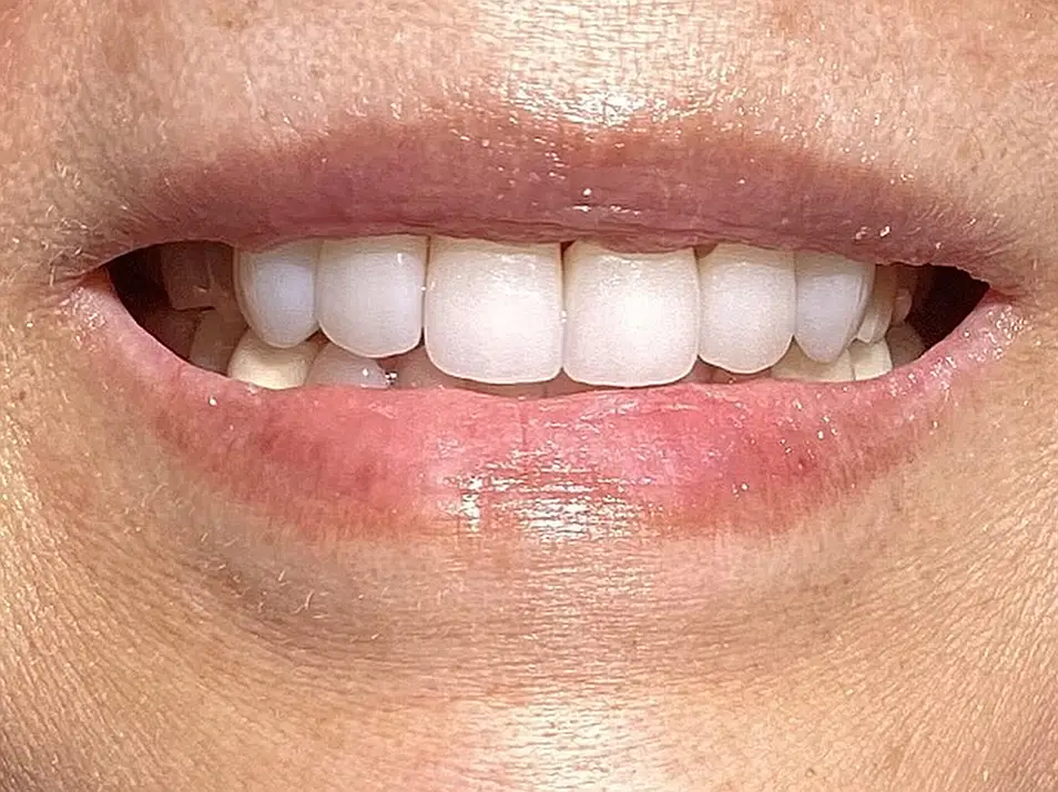 precision dental care case 02 after 1