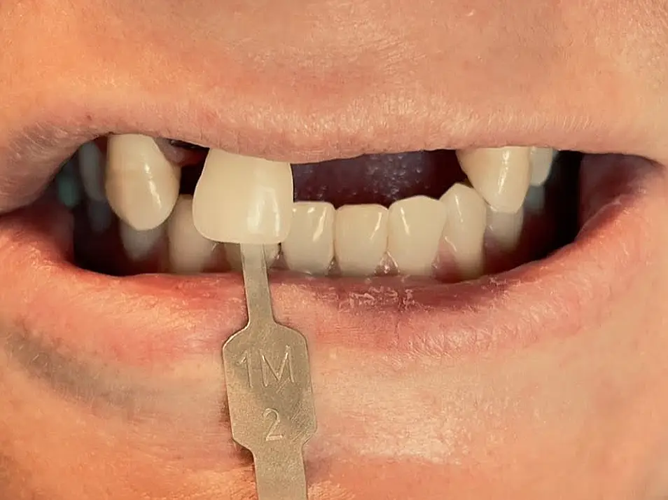 precision dental care case 4 01