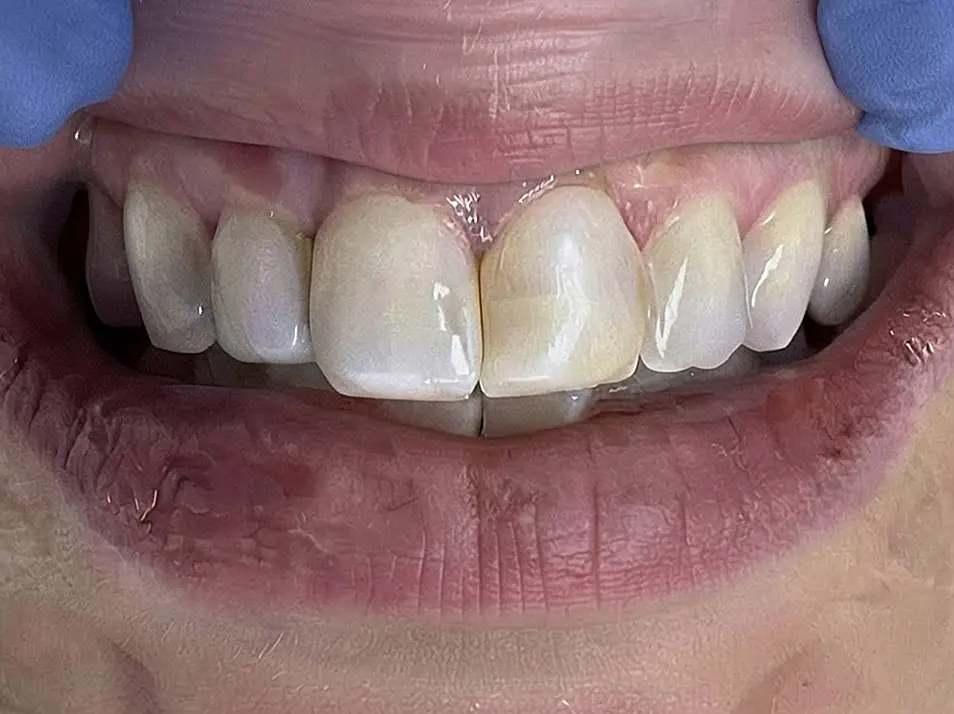 precision dental care case 6 01