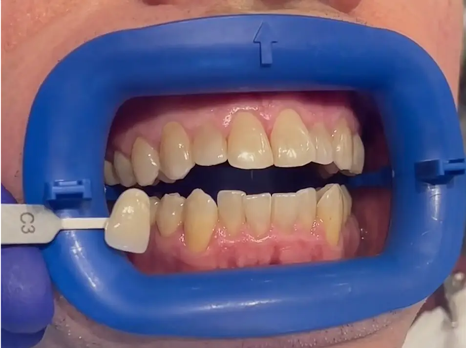 precision dental care case 7 01