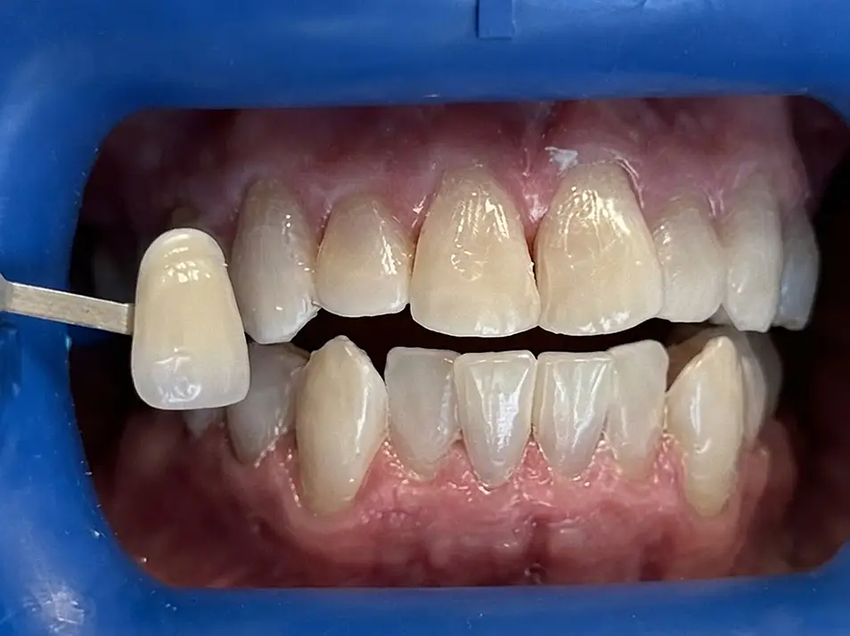 precision dental care case 7 02